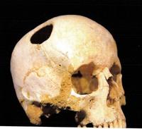A neolithic skull unearthed after some 6000 years. The smooth edges of the trephine suggest healing and survival.